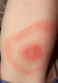 Bulls eye rash from Lyme Disease Erythma Migrans